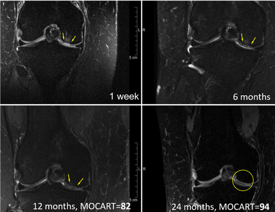 Regentis' GelrinC Demonstrates Breakthrough in Regenerating Native-Like Cartilage Structure in Knee Repair on MRI Results Confirmed Using a Validated, Regulator-Accepted Method